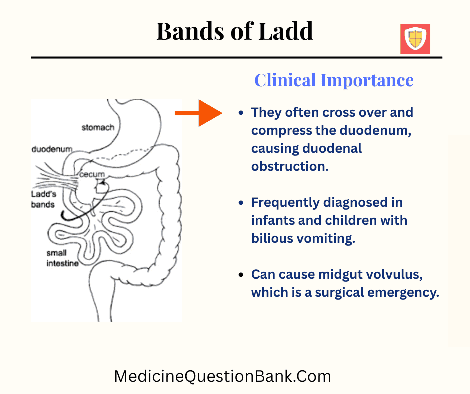 Bands of Ladd are peritoneal fibrous adhesions that extend from the cecum to the right lateral abdominal wall or retroperitoneum, commonly seen in congenital intestinal malrotation.
Bands of Ladd, intestinal malrotation, congenital intestinal obstruction, neonatal bilious vomiting, duodenal obstruction, cecal malposition, midgut volvulus, whirlpool sign ultrasound, corkscrew appearance contrast study, Ladd’s procedure, division of Ladd bands, widened mesenteric base, right-sided small intestine, left-sided colon, neonatal intestinal surgery, congenital GI anomalies, duodenal compression, appendectomy with Ladd’s, short bowel syndrome risk, intestinal ischemia in neonates, surgical management of malrotation.