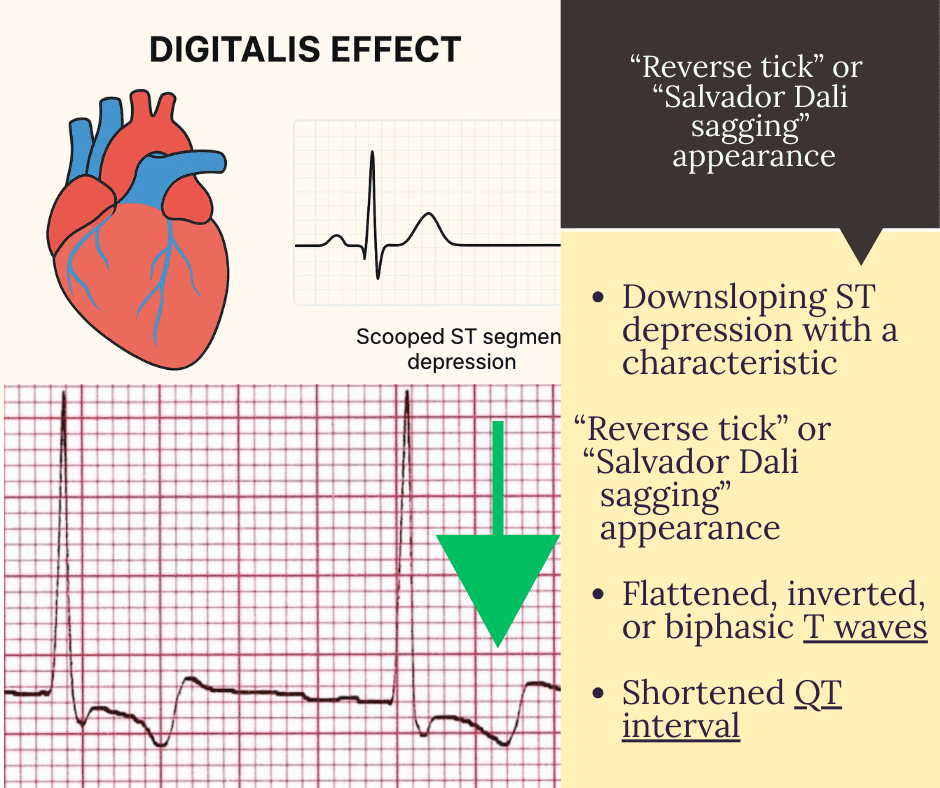 Digitalis effect on ECG showing scooped ST depression
Heart illustration with digoxin-induced ECG changes
Digitalis therapy ECG changes – ST segment scooping
ECG graph demonstrating digitalis effect
Educational infographic: Digitalis effect on heart and ECG