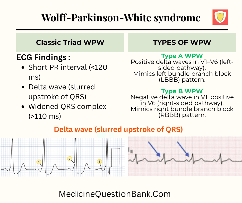 Types of Wolff–Parkinson–White (WPW) syndrome, Wolff–Parkinson–White syndrome, WPW syndrome, WPW pattern