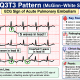 S1Q3T3 Pattern