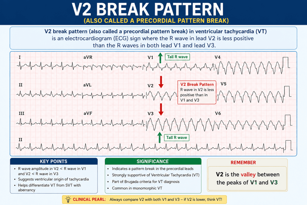 V2 break pattern (also called a precordial pattern break) ECG