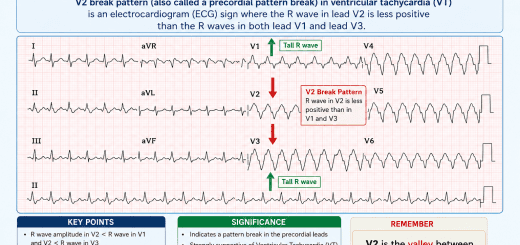 V2 break pattern (also called a precordial pattern break) ECG