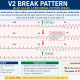 V2 break pattern (also called a precordial pattern break) ECG