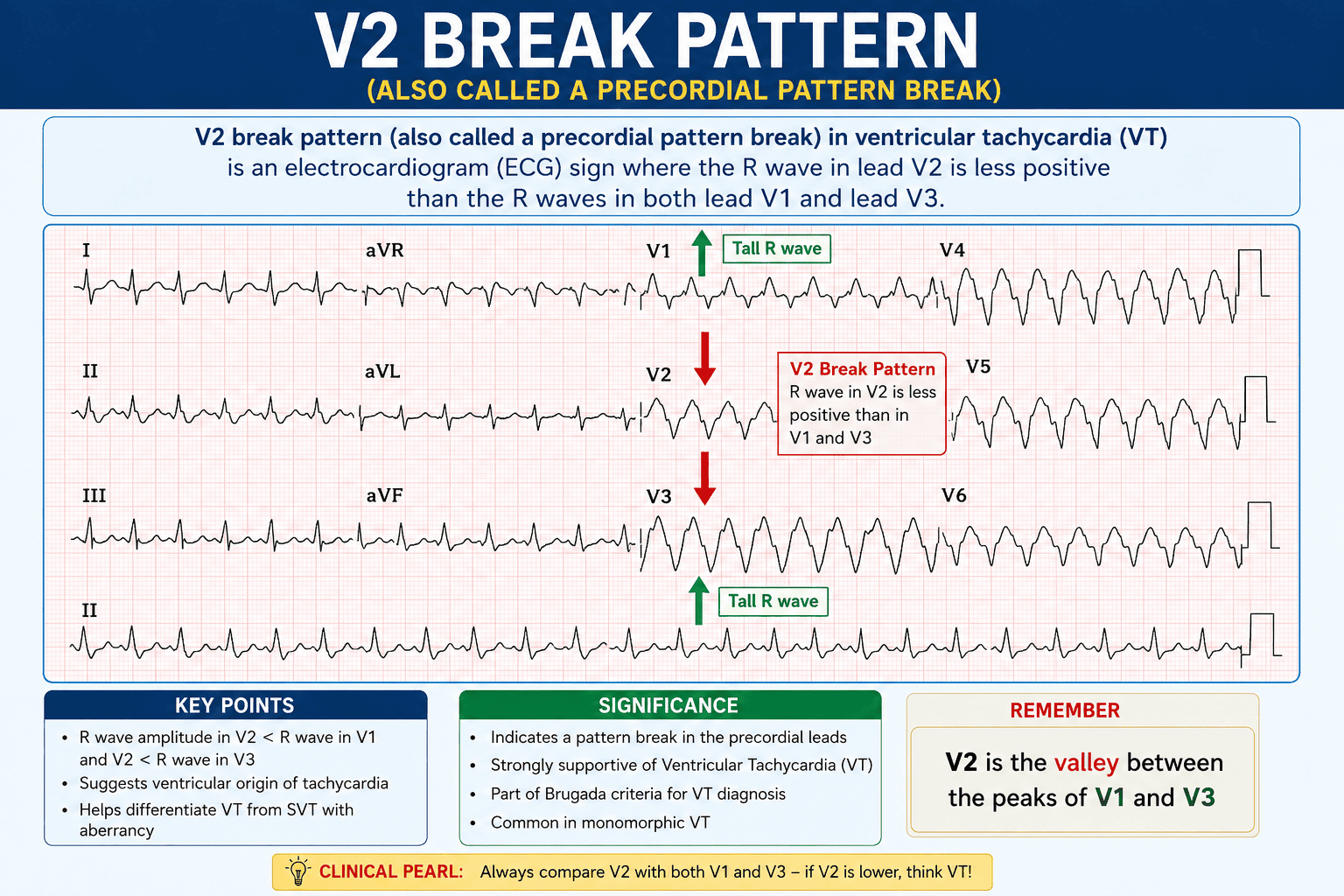 V2 break pattern (also called a precordial pattern break) ECG